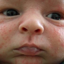 Аллергия на лице: причины, симптомы, фото, лечение