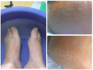 Шелушение кожи на ногах: причины, симптомы и лечение