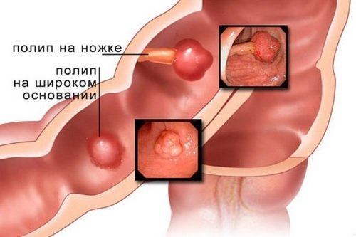 Боль в прямой кишке болезни симптомы диагностика лечение профилактика рекомендации