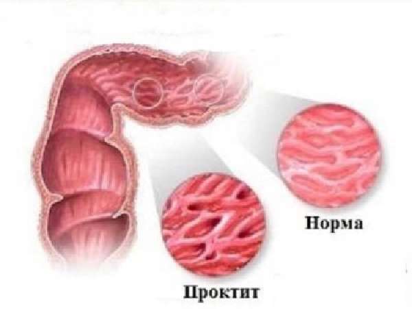 Боль в прямой кишке болезни симптомы диагностика лечение профилактика рекомендации