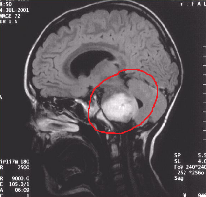 Глиома ствола мозга. последствия, фото и прогноз
