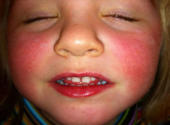 Красные щеки у ребенка и взрослого - симптом гиперемии, аутоиммунных болезней, гипертонии и аллергии