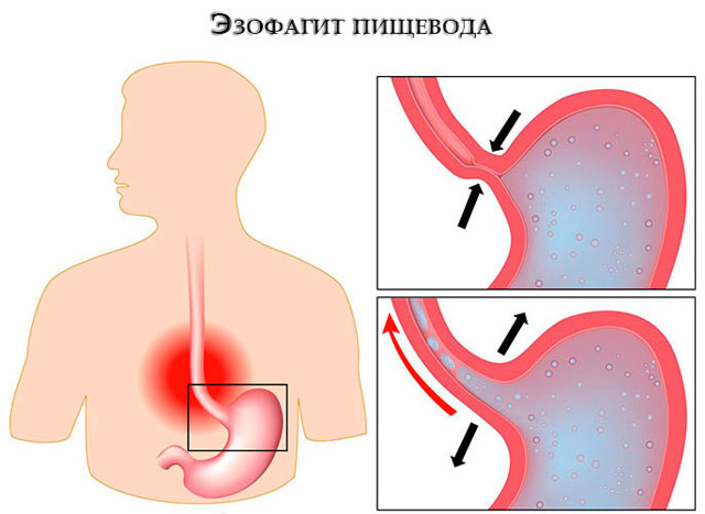 Воспаление пищевода: симптомы, причины, лечение