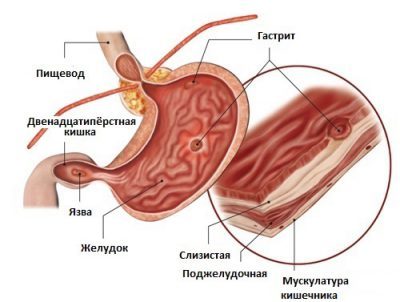 Болит желудок после еды: причины и лечение