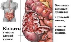 Боль в прямой кишке болезни симптомы диагностика лечение профилактика рекомендации