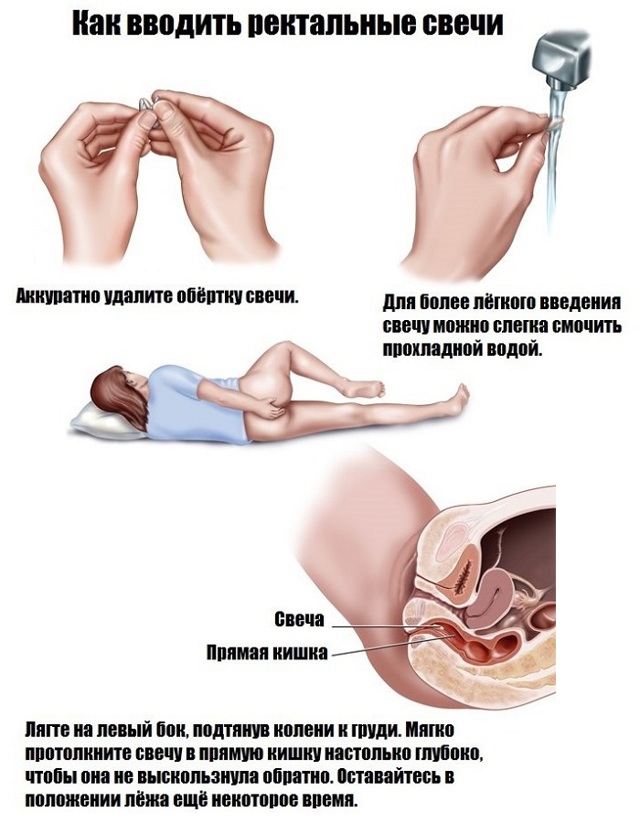 Дикловит свечи при простатите