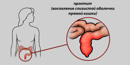 Боль в прямой кишке болезни симптомы диагностика лечение профилактика рекомендации