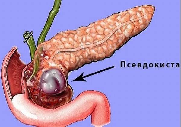 Полипы в поджелудочной железе: причины и лечение