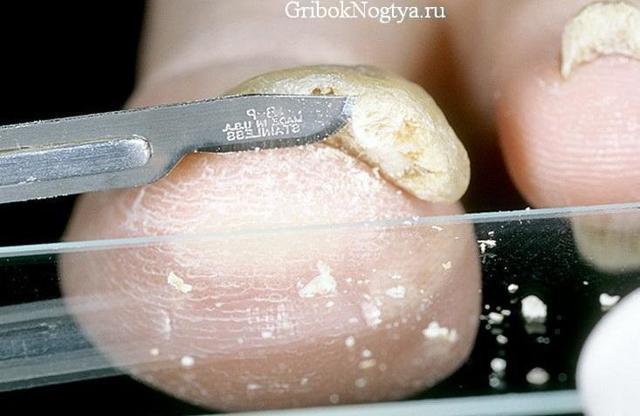 Как готовиться к соскобу на грибок кожи и ногтей, где сдать