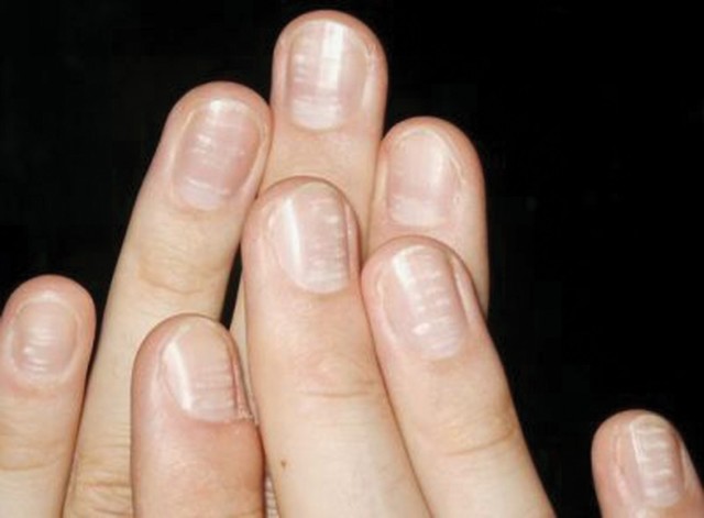 Слоятся ногти на руках – причины, что делать, когда сильно слоятся ногти на руках, лечение