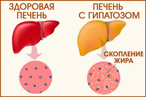 Гепатомегалия жировой печени