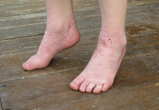 Инфекционный дерматит на ногах – лечение мазью