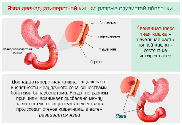 Диета при язве двенадцатиперстной кишки - что можно есть, рецепты