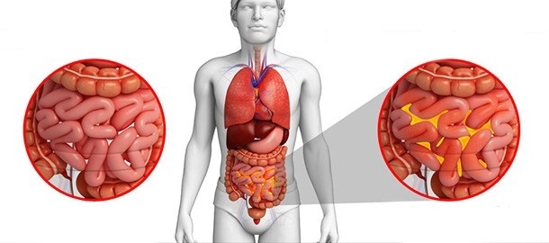 Гнойный перитонит – виды, причины, симптомы и лечение