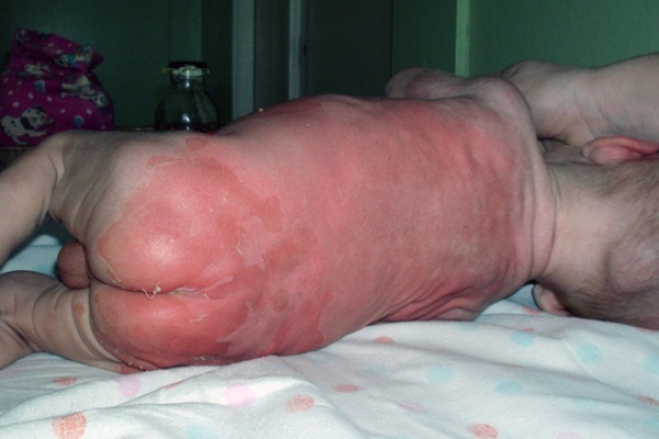 Эксфолиативный дерматит (болезнь Риттера синдром ошпаренной кожи) – что это такое?