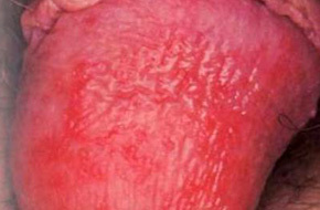 Красные пятна на головке члена у мужчины: причины появления сыпи, симптомы, диагностика и лечение заболеваний медикаментозными препаратами, правила гигиены и профилактика рецидивов