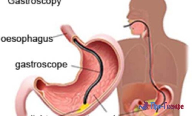 Показания и противопоказания к проведению процедуры ФГДС