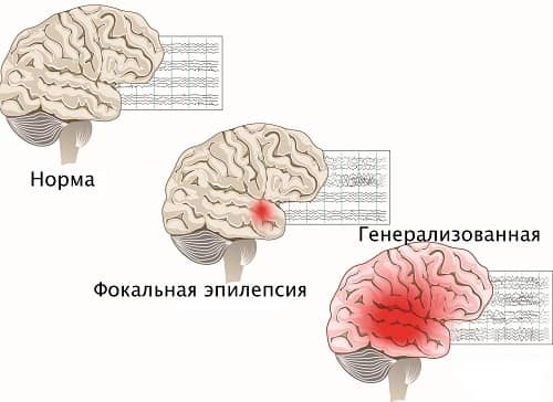 Приступ эпилепсии у человека: причины, симптомы, лечение