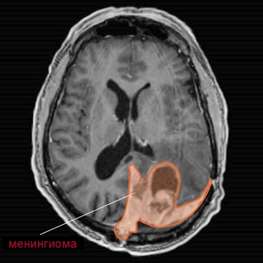 Чем вызвана менингиома головного мозга - причины, симптомы, лечение