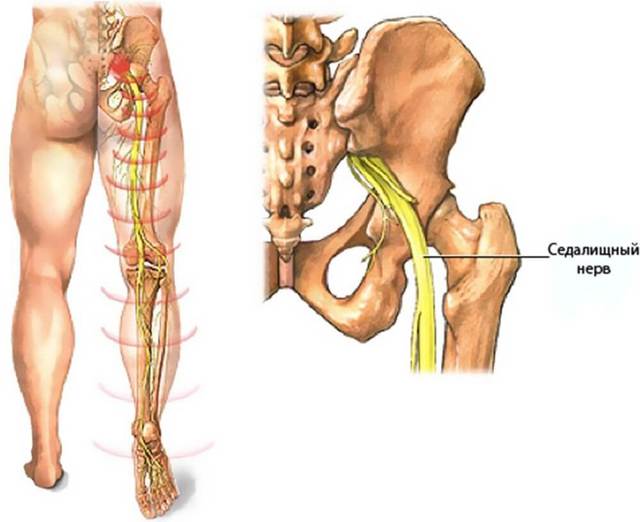 Воспаление седалищного нерва - симптомы и лечение защемления седалищного нерва