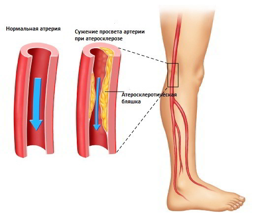 Народные средства лечения атеросклероза нижних конечностей - как вылечить атеросклероз ног