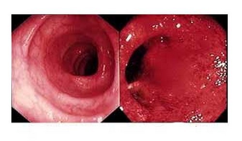 Катаральный колит кишечника: описание, причины, симптомы и лечение