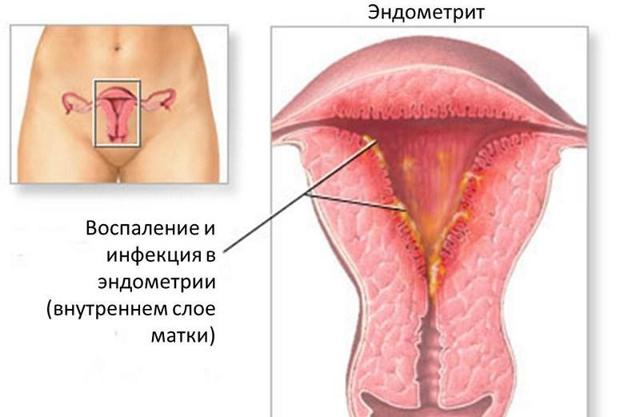 Белые точки на половых губах и влагалище