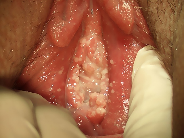 Грибок во влагалище: причины, симптомы и лечение вагинального кандидоза