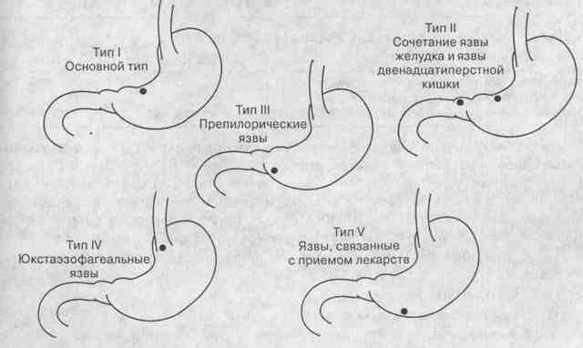 Лечение язвы желудка и двенадцатиперстной кишки медикаментами