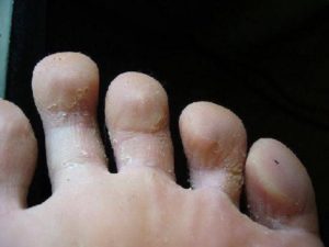 На ступнях ног слезает кожа – фото, причины у взрослых, детей