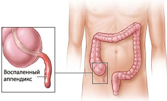 Может ли быть понос при аппендиците и как его лечить