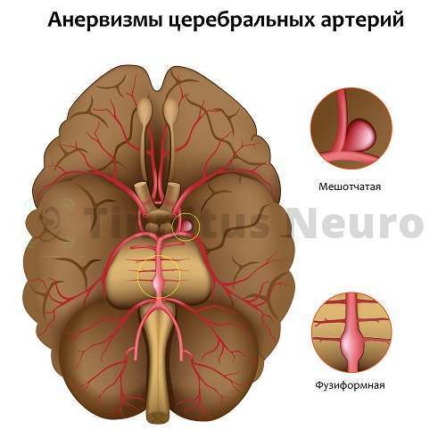 Пульсирующий шум в ухе – куда обращаться и как вылечить?