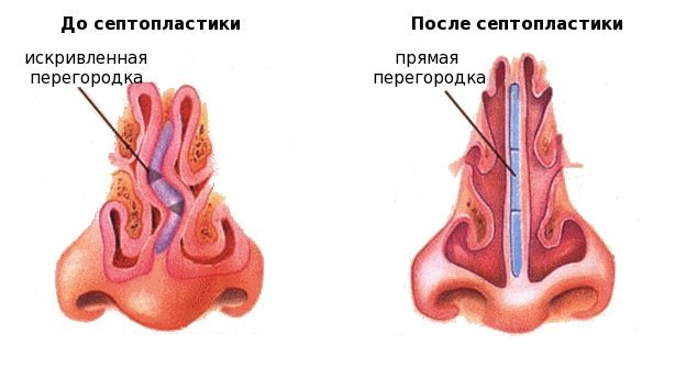 Искривление носовой перегородки картинки