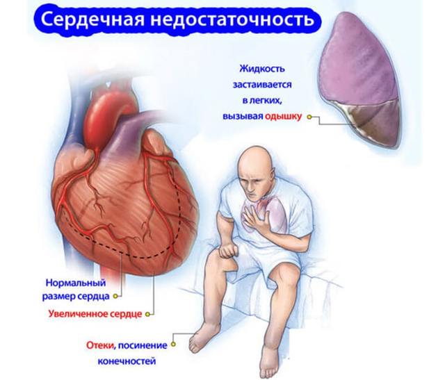 Давление 130 на 90: что это значит, что делать