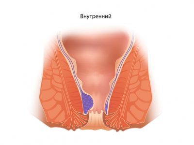 Внутренний и наружный геморрой: чем отличается лечение