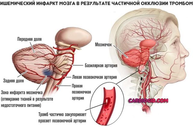 Инфаркт головного мозга – что это такое? Ишемический, лакунарный, обширный инфаркт головного мозга – причины, симптомы, лечение и последствия