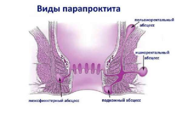 Боль в прямой кишке болезни симптомы диагностика лечение профилактика рекомендации