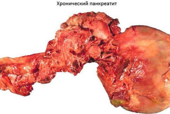 Симптомы панкреатита у мужчин и лечение народными средствами