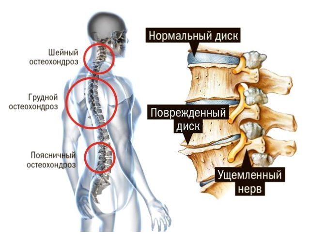 Слабость в ногах при остеохондрозе: причины и лечение
