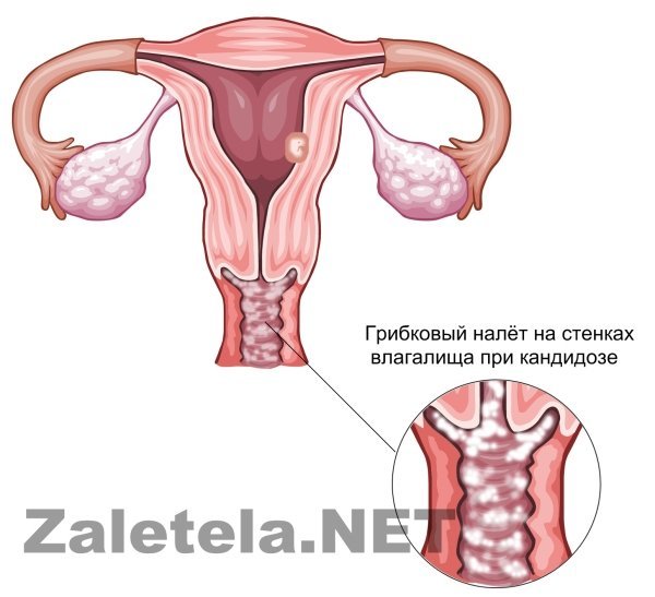 Симптомы молочницы у беременных женщин