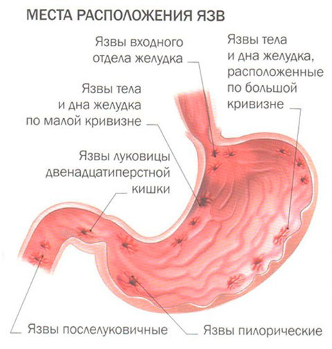 Симптомы язвы желудка и 12 перстной кишки: самые популярные причины и симптомы язвы