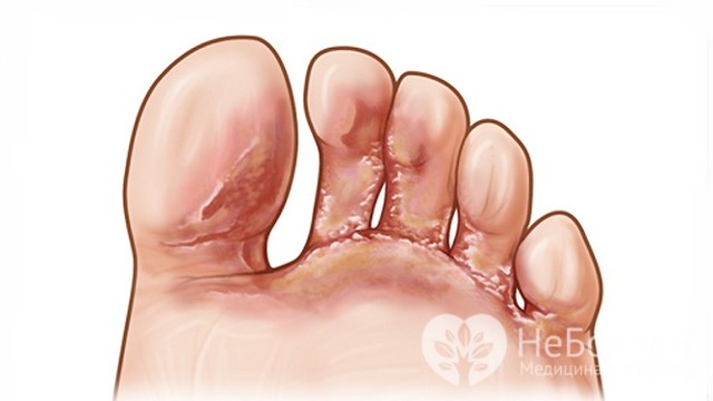 Грибок стопы - причины, признаки и симптомы, лечение