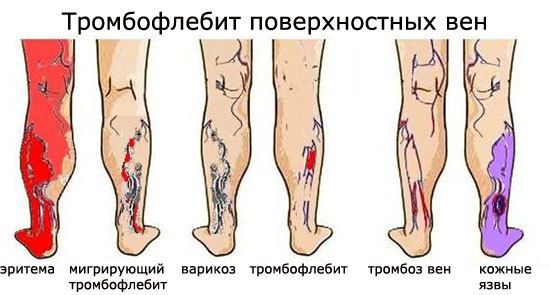 Жжение в ногах ниже колена: причины и лечение, что делать в домашних условиях когда они горят