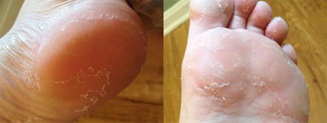 Шелушение кожи на ногах: причины, симптомы и лечение
