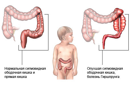 Болезнь Гиршпрунга у детей: симптомы, лечение, фото