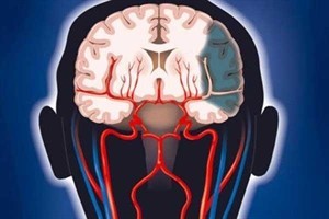 Нарушение венозного оттока крови головного мозга: симптомы и лечение дисциркуляции