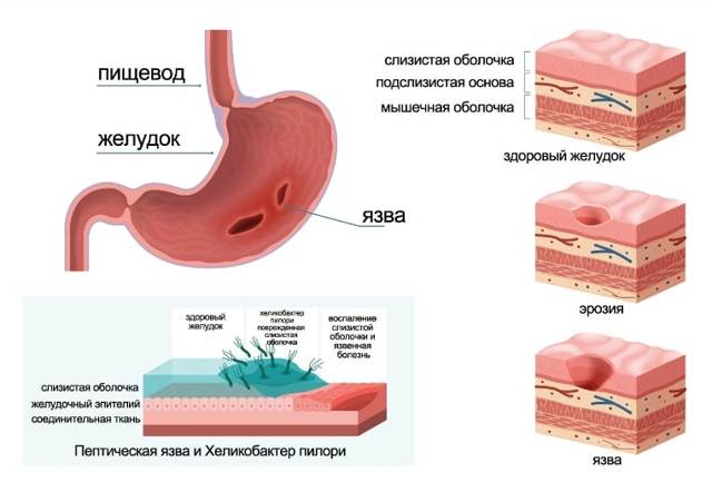 Симптомы и лечение желудка самыми эффективными народными средствами в домашних условиях