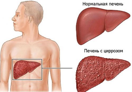 Болезни печени и поджелудочной железы: симптомы и лечение