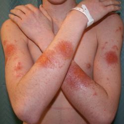 Атопический дерматит у детей: фото, симптомы и лечение