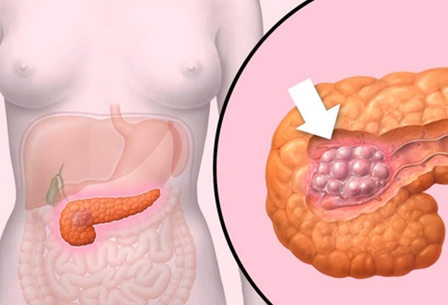 Рак поджелудочной железы 4 стадия: сколько живут при онкологии поджелудочной железы 4 степени